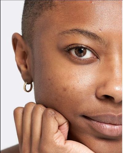 Guide to post-acne marks.
