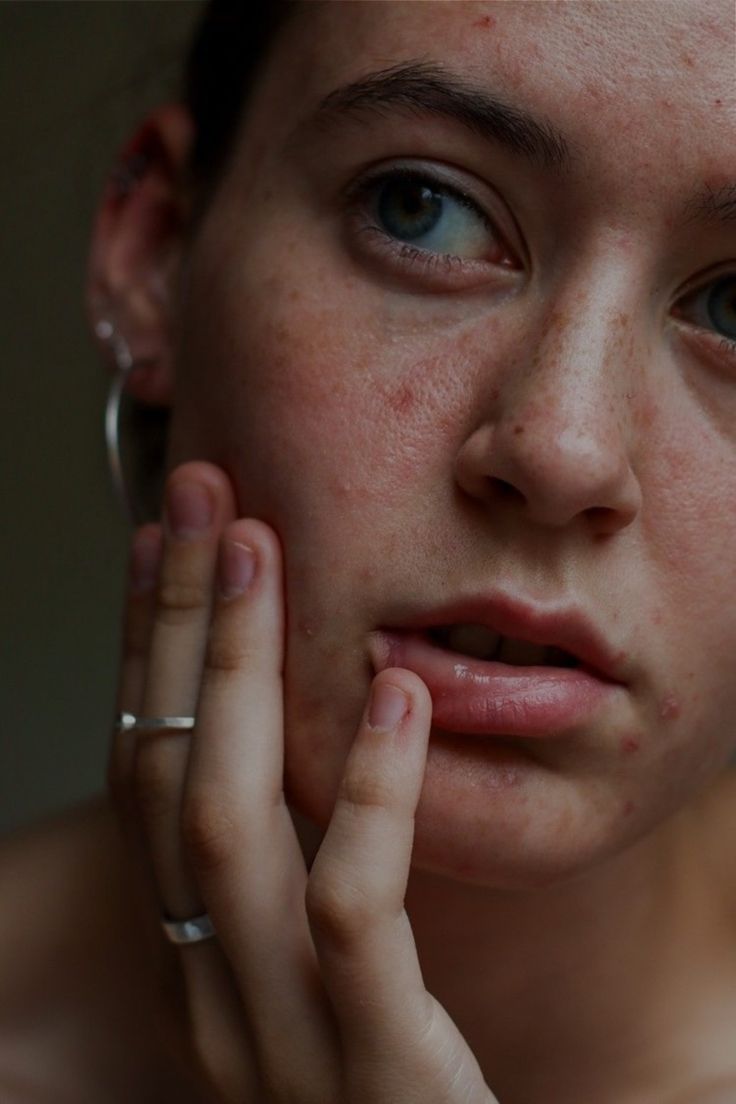 Purging vs. Breakouts